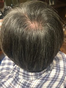 Before ケアを始める前の状態です